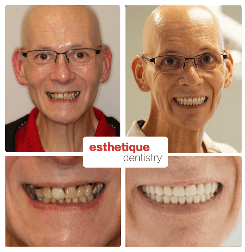 Before and after - Eustachio W.
