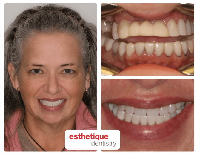 Before and after — Marcy P.