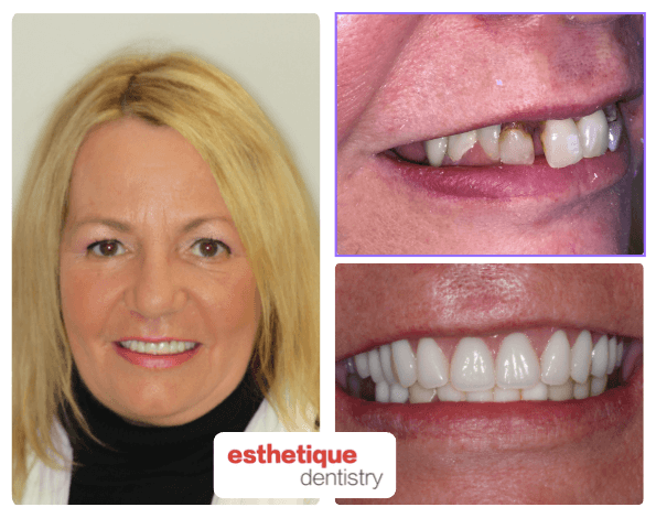 Before and after - Susan W.