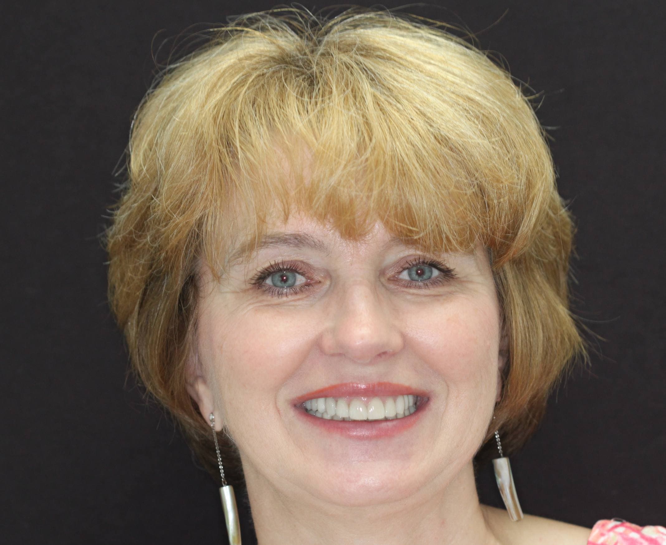 Veneers: after