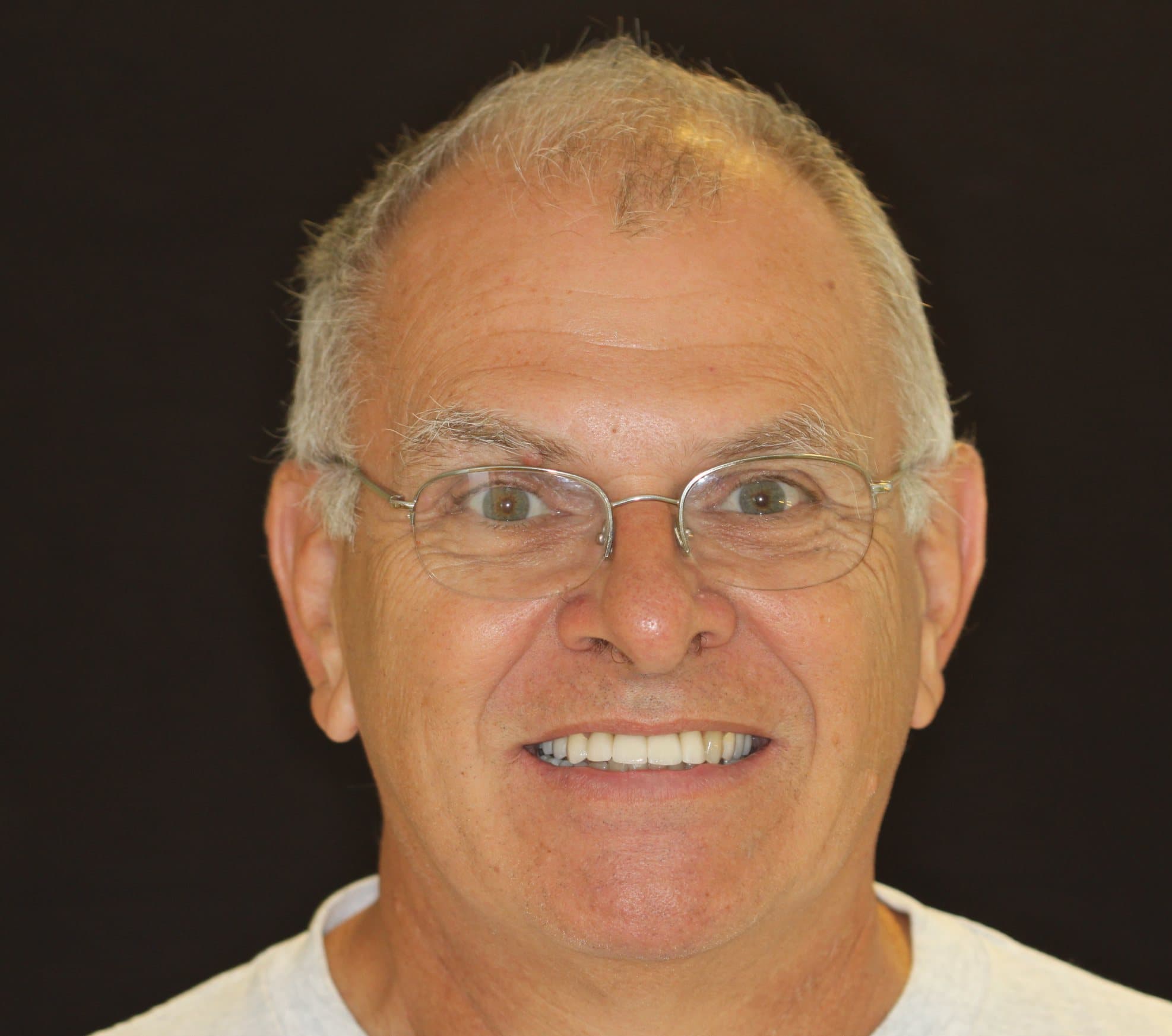 Dental Implants: after