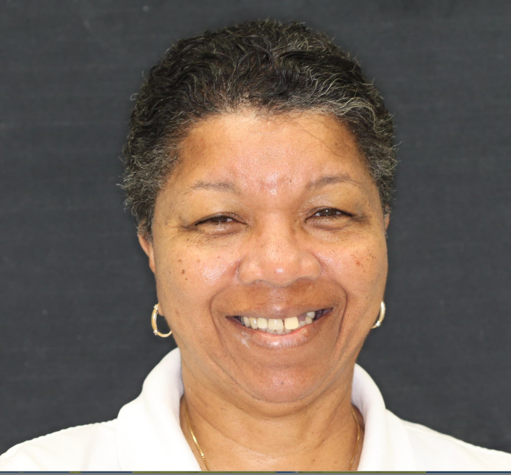 Smile Makeover: before