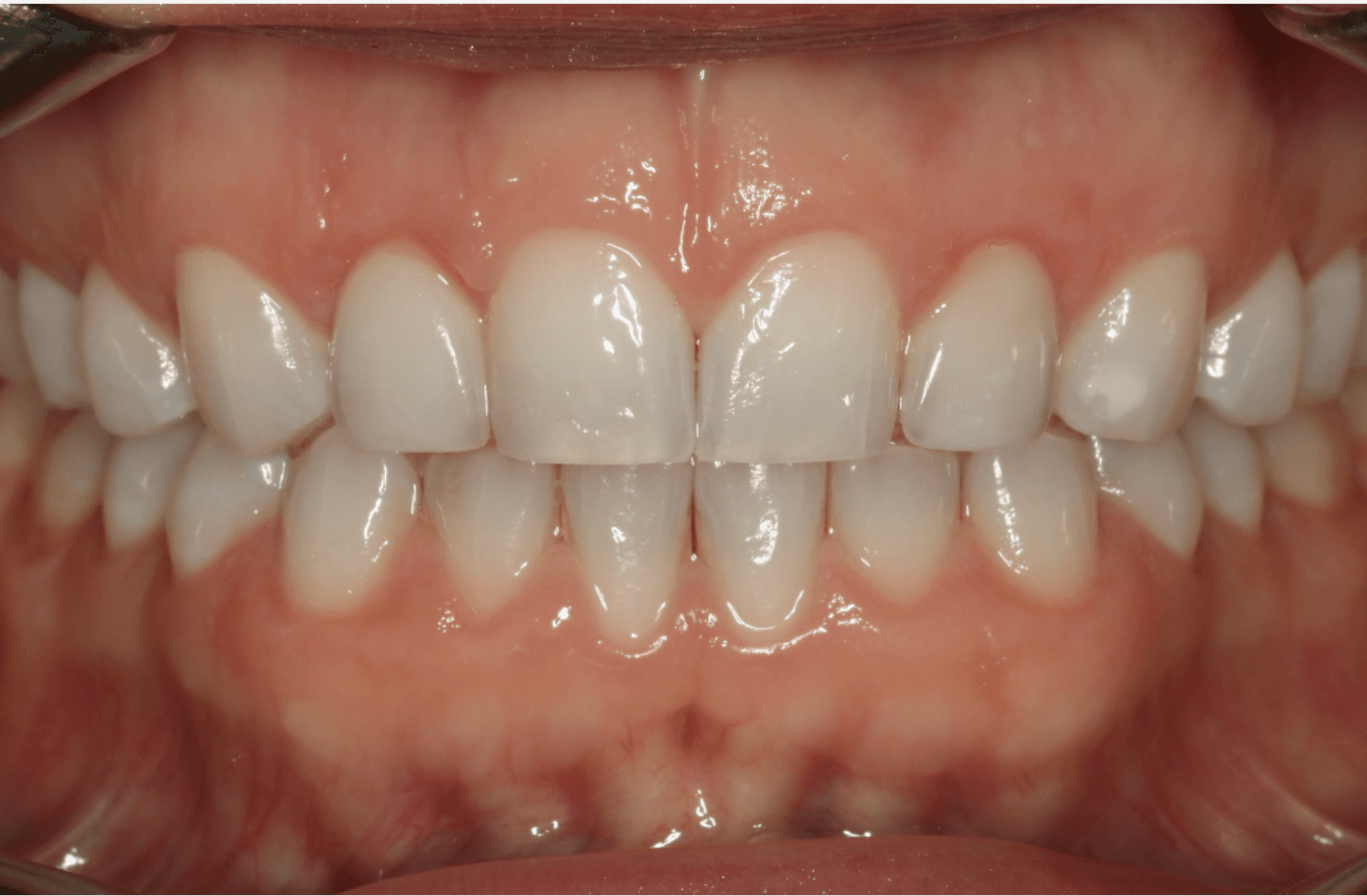Porcelain Veneer Smile Makeover: after