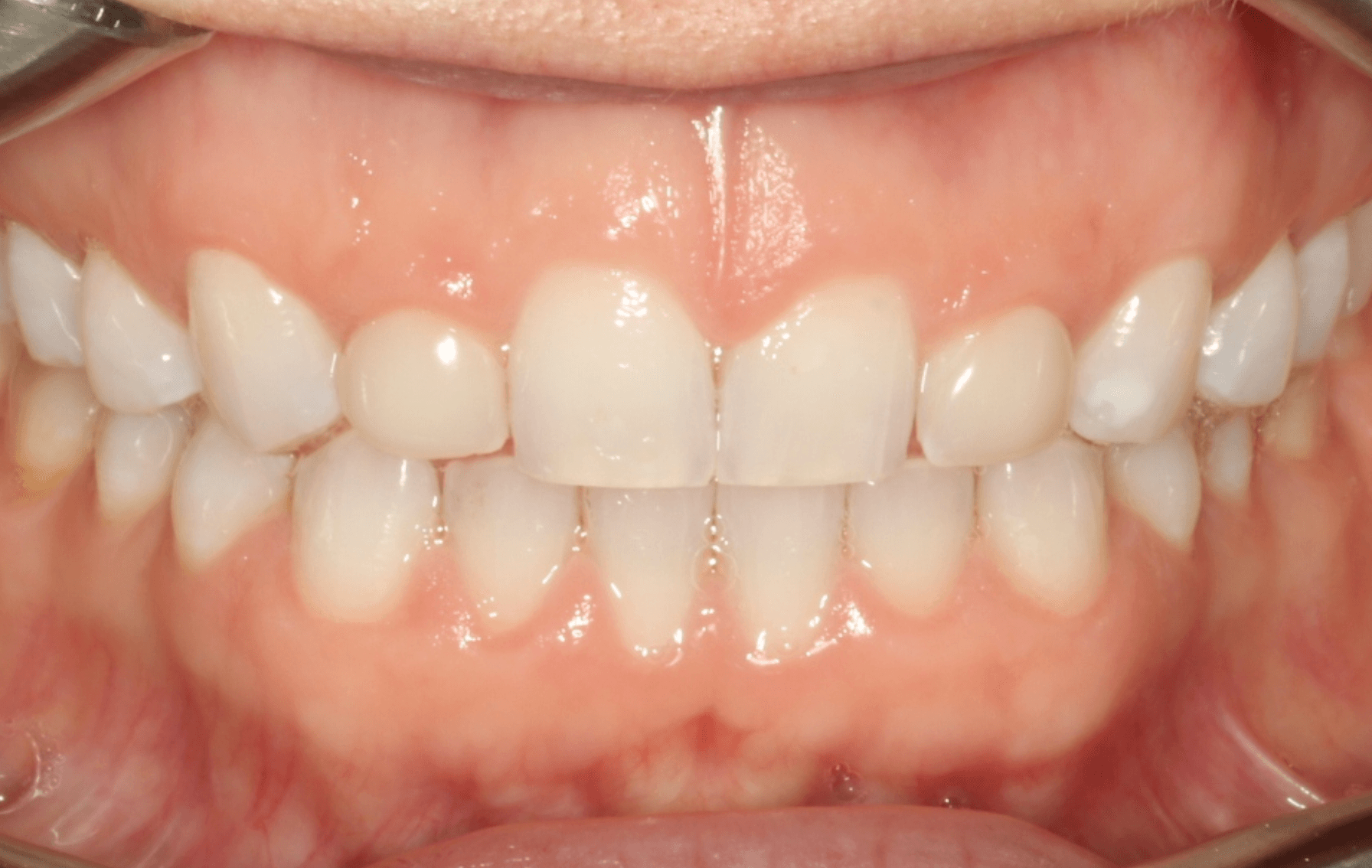 Porcelain Veneer Smile Makeover: before
