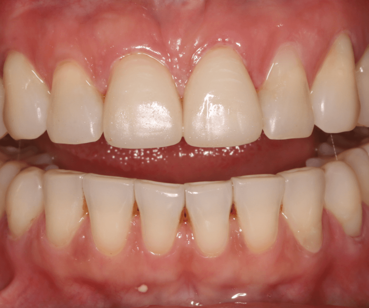 Chipped Tooth Veneer Restoration: after