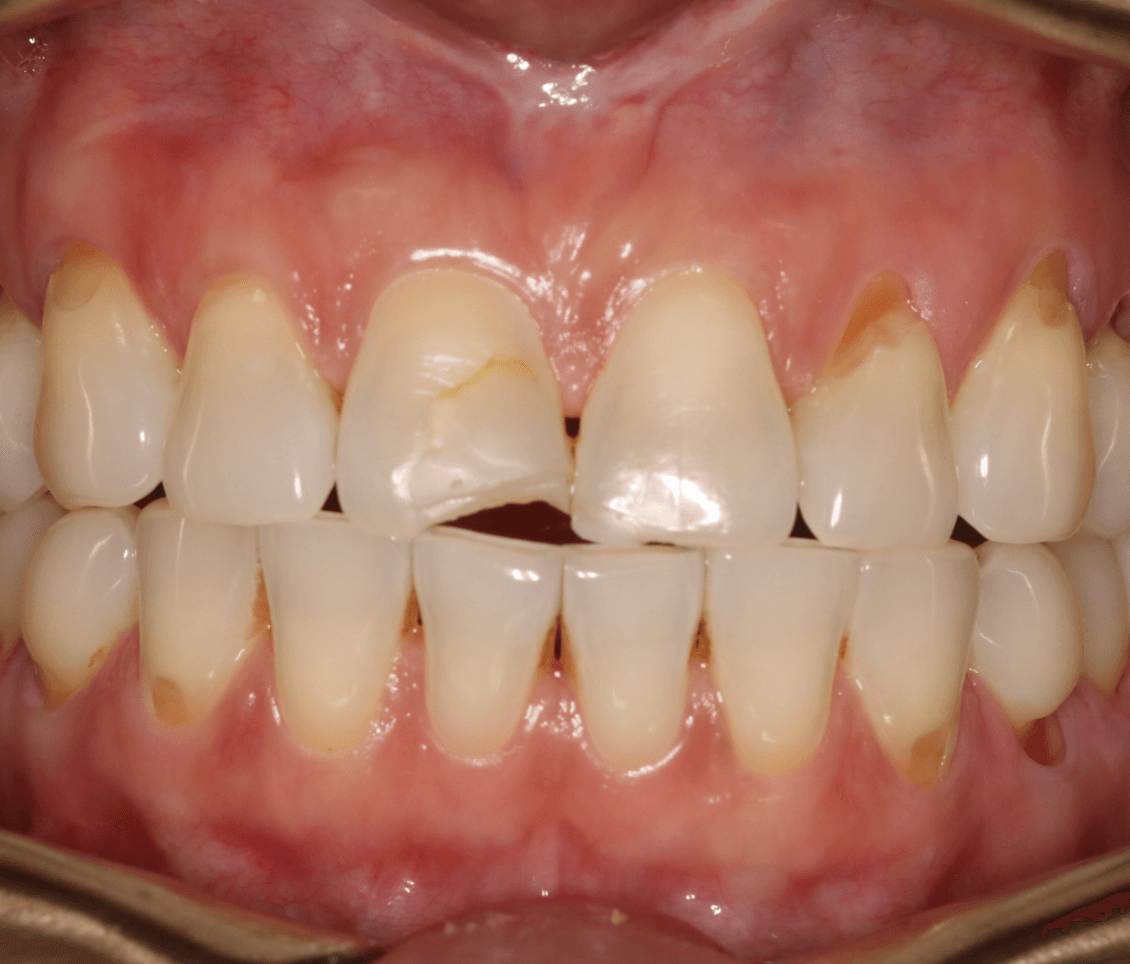 Chipped Tooth Veneer Restoration: before