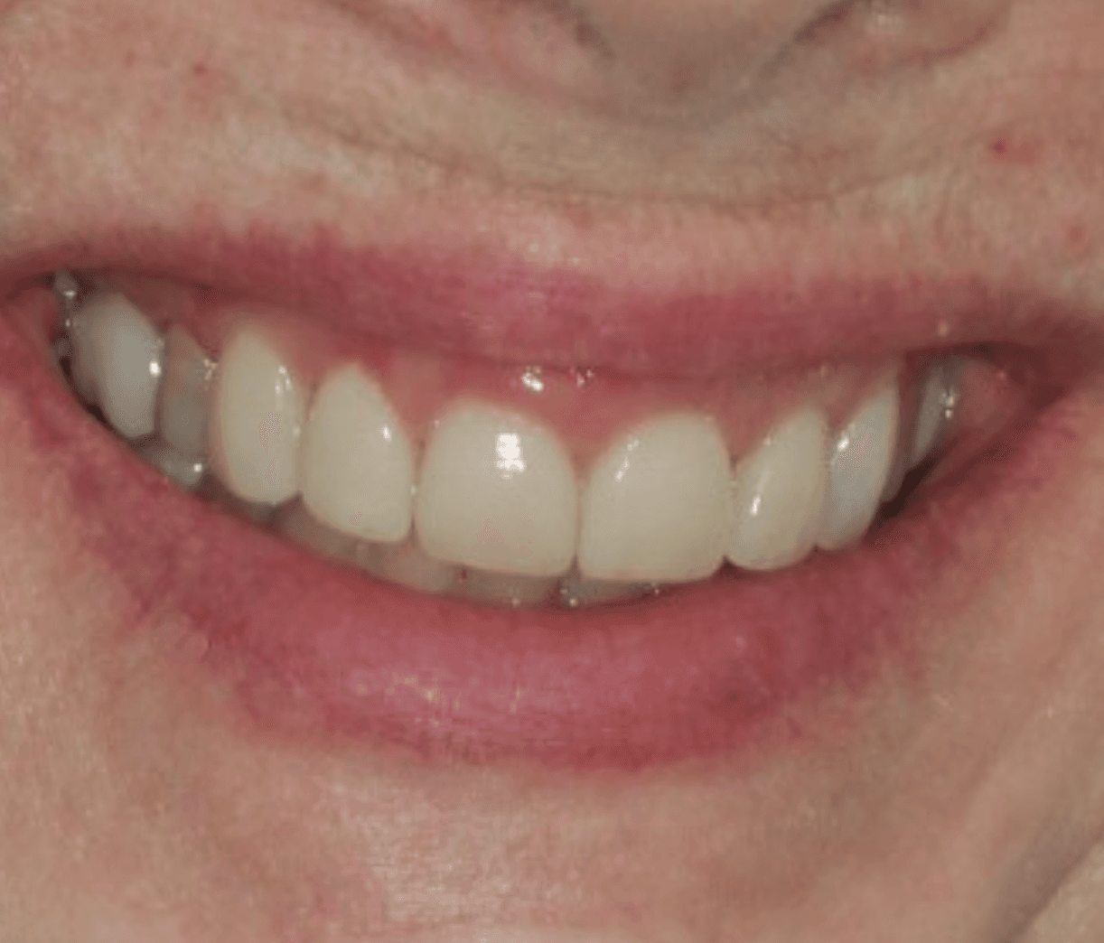 Worn & Stained Teeth Veneers: after