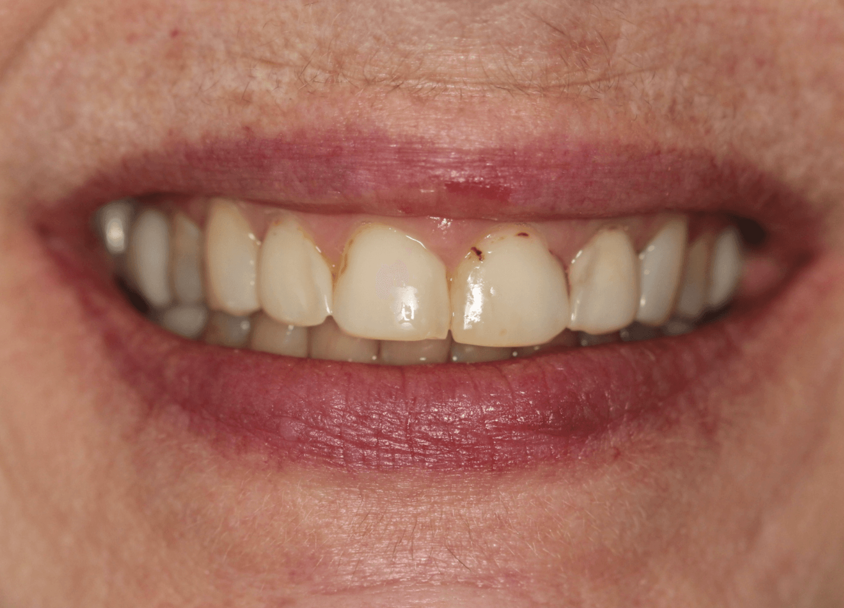 Worn & Stained Teeth Veneers: before