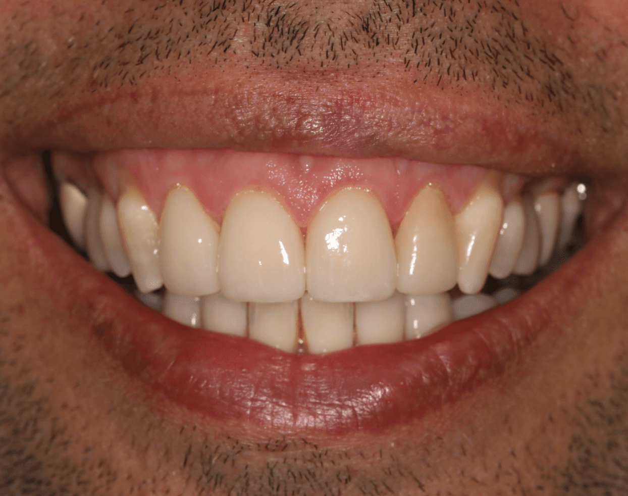 Smile Veneer Makeover: after