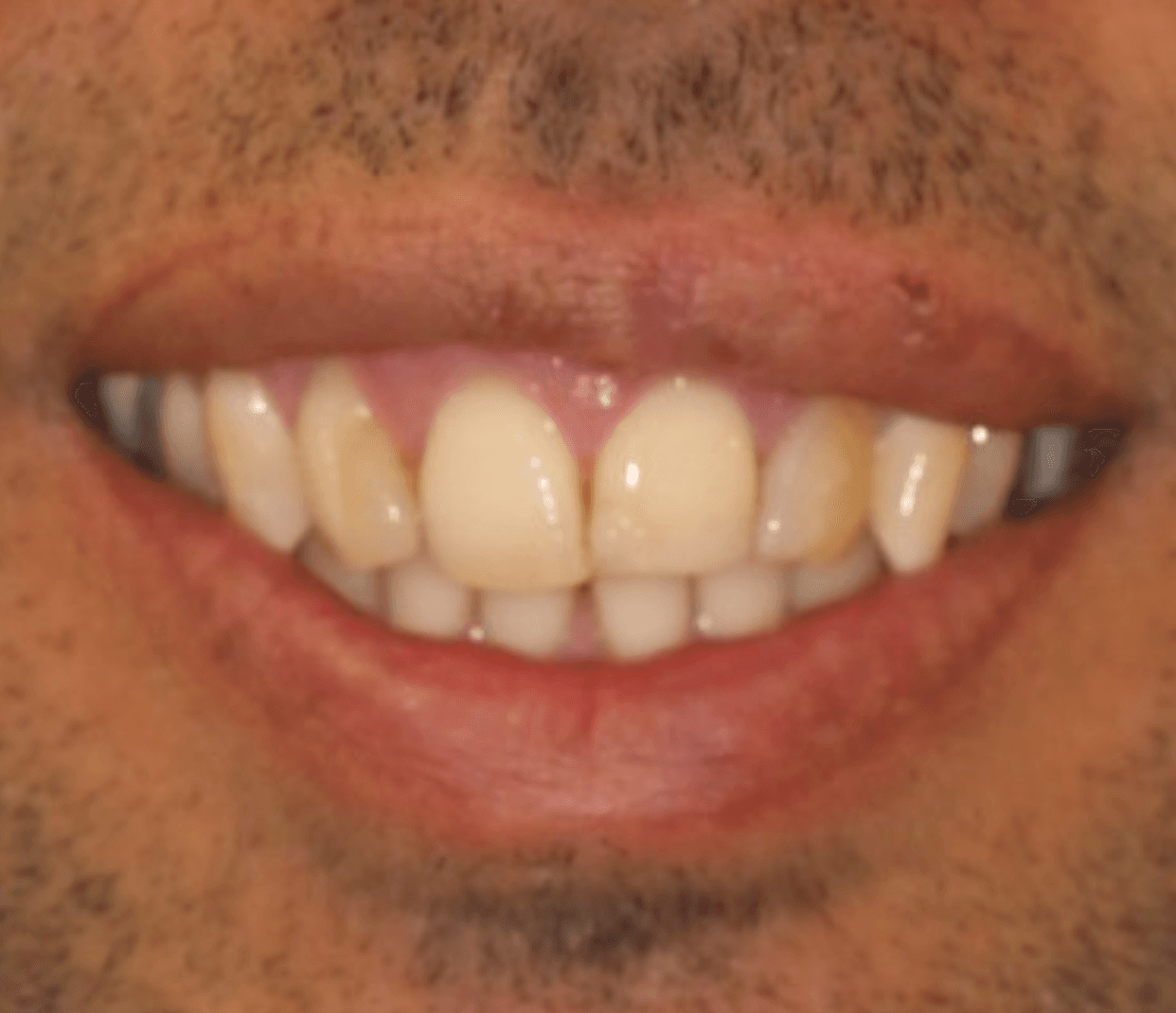 Smile Veneer Makeover: before