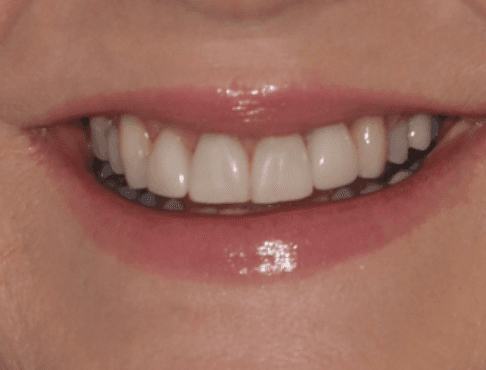 Uneven Teeth Veneer Makeover: after