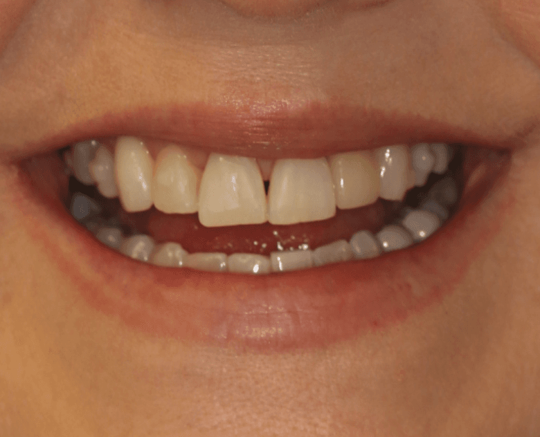 Uneven Teeth Veneer Makeover: before