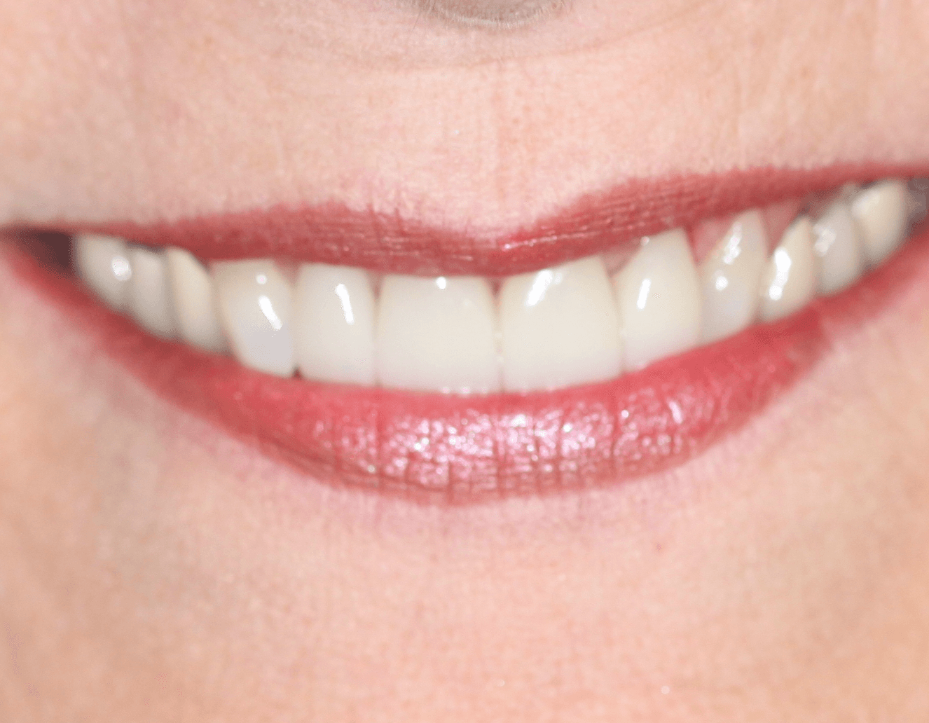 Discolored Teeth Veneer Makeover: after