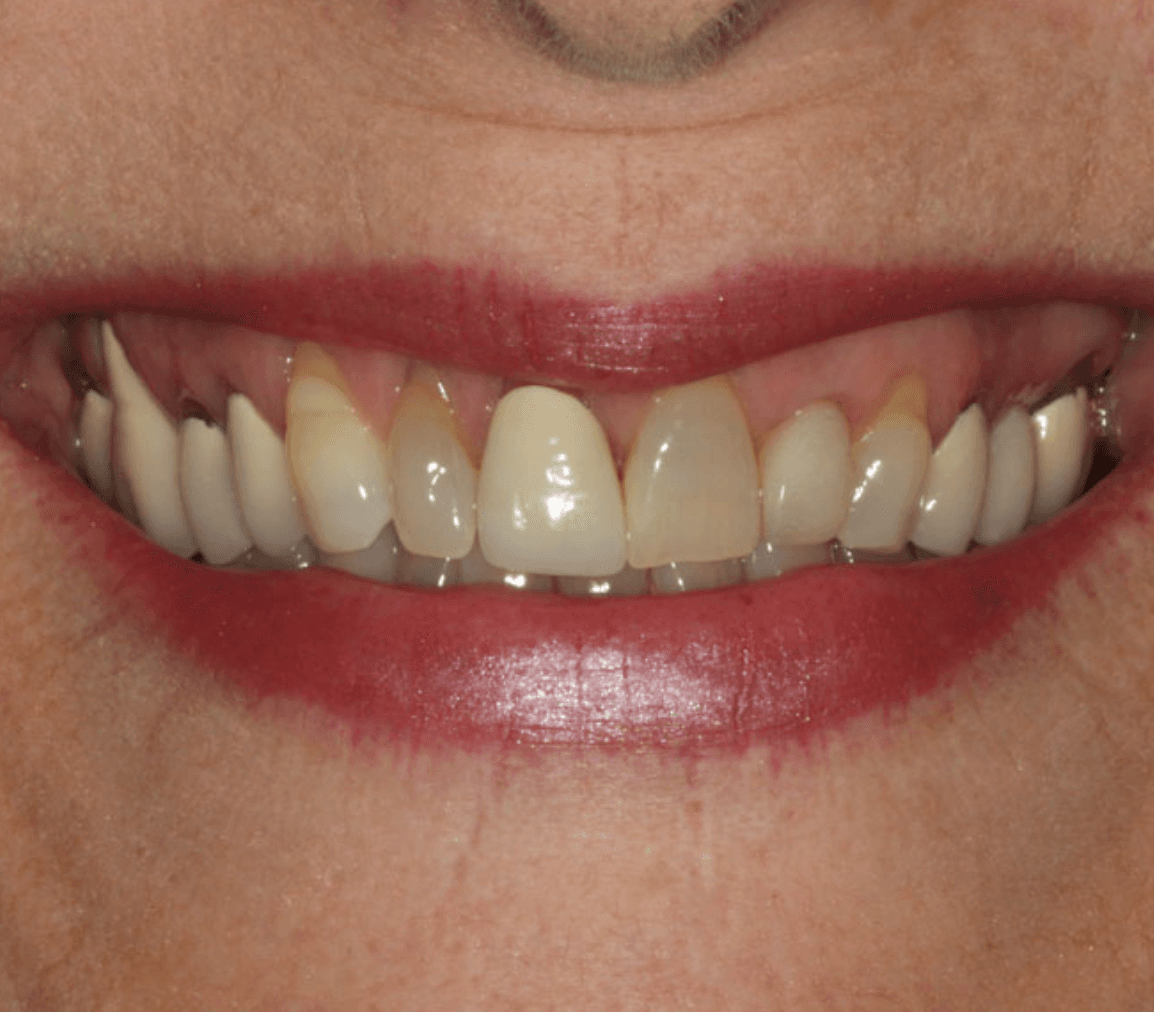 Discolored Teeth Veneer Makeover: before