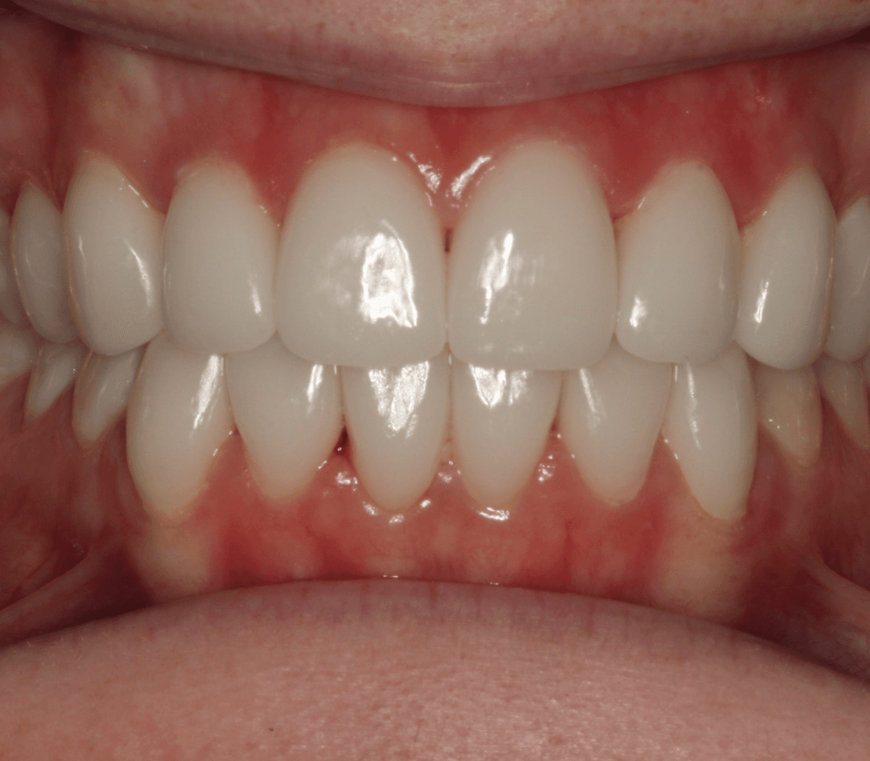 Full Porcelain Veneer Smile: after