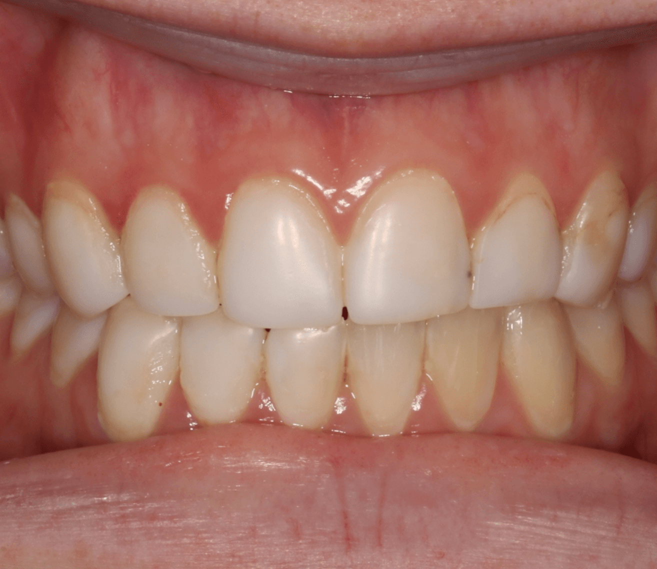Full Porcelain Veneer Smile: before