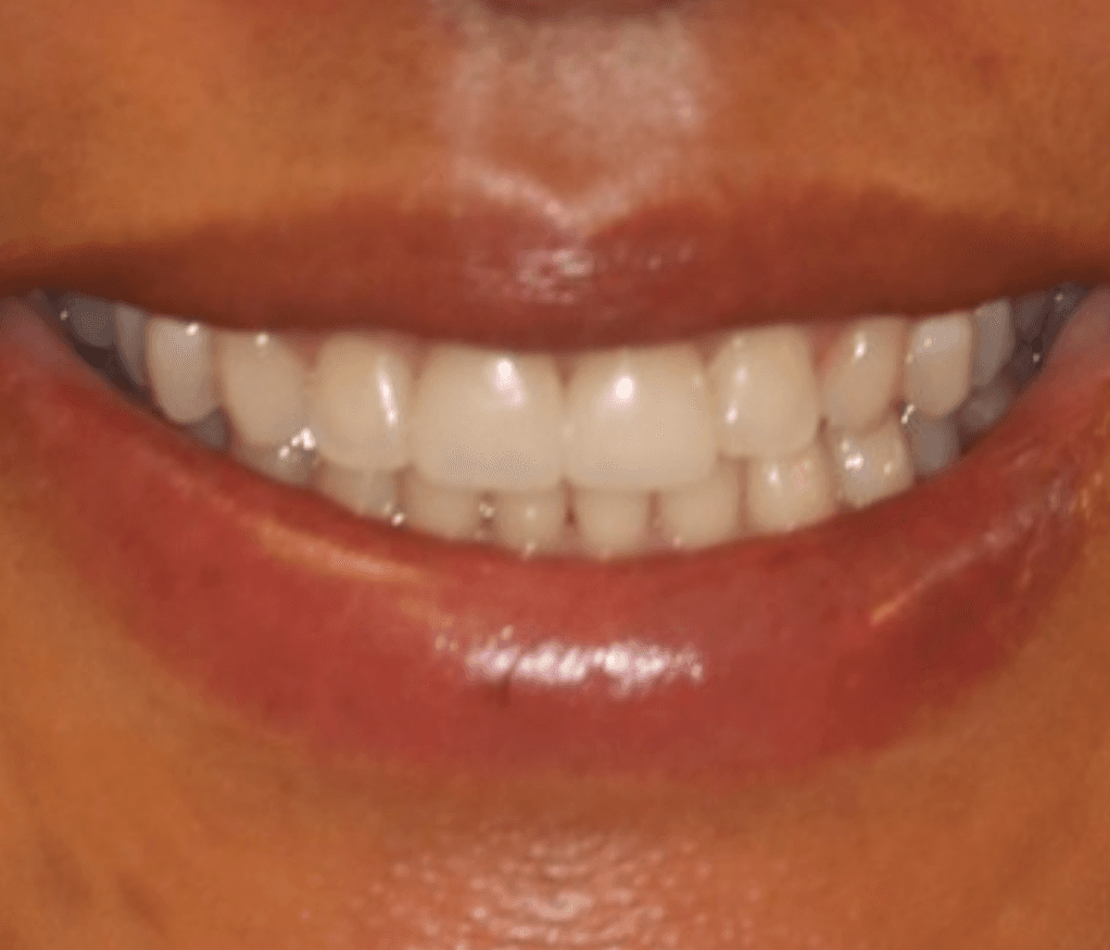 Worn Teeth Veneer Restoration: after