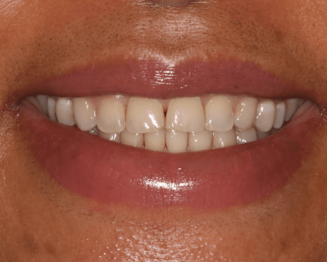 Worn Teeth Veneer Restoration: before