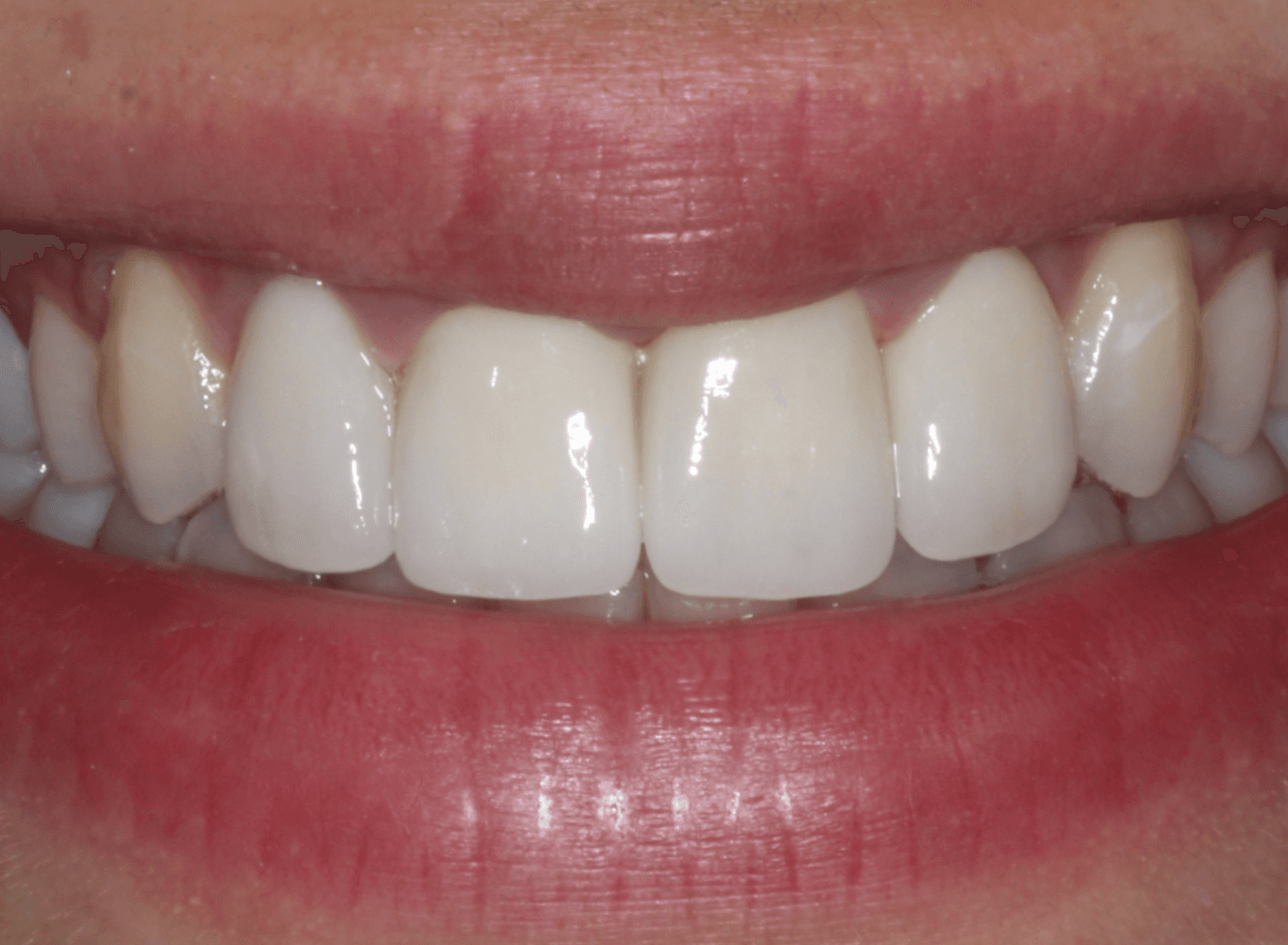 Chipped & Stained Teeth Veneers: after