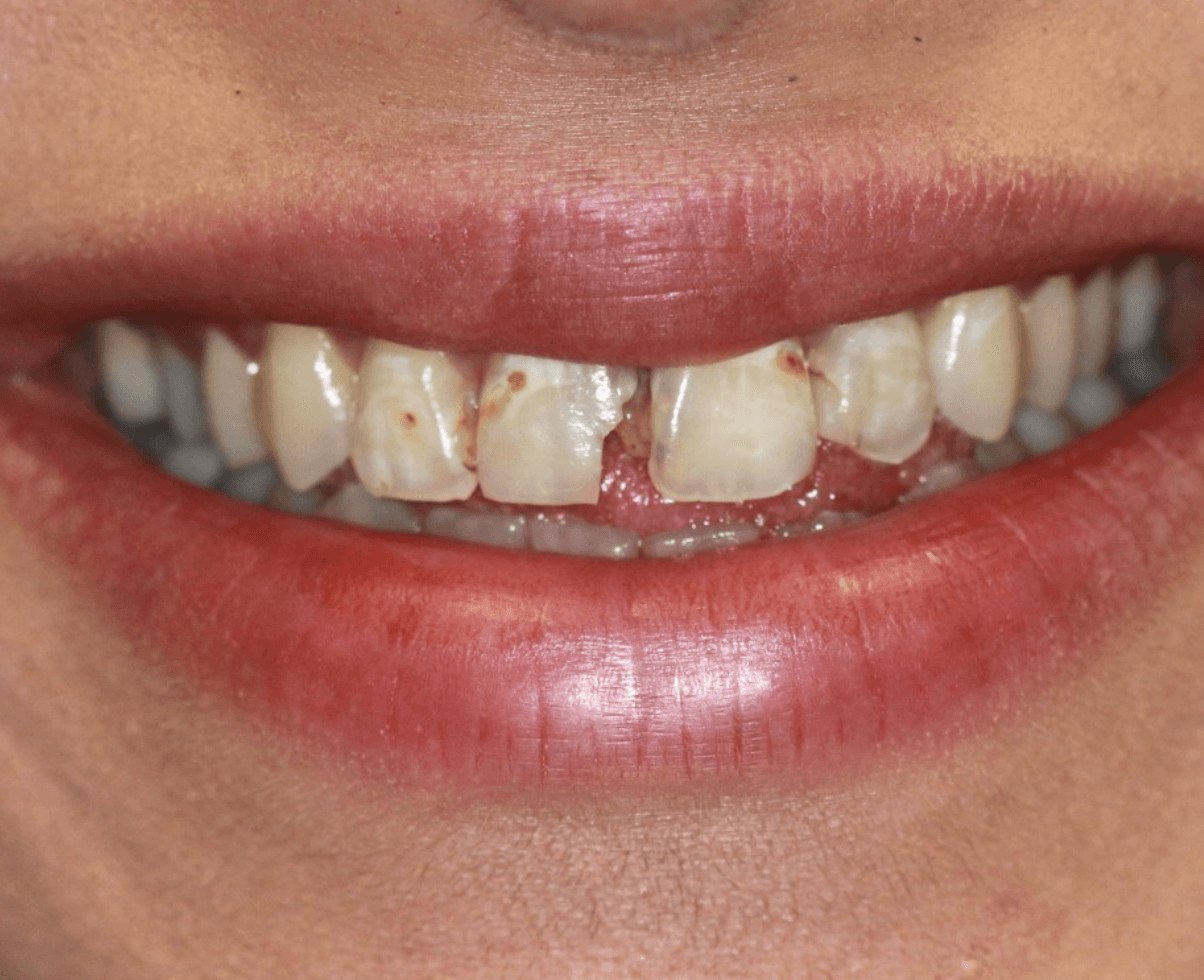 Chipped & Stained Teeth Veneers: before